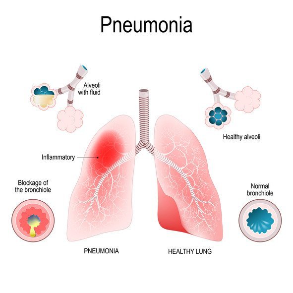 Symptoms of pneumonia, causes and treatment methods GreenBHL