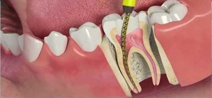 Teeth diseases and treatment