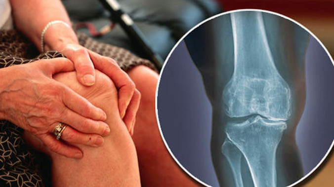 Osteoartrite: comprensione delle cause, dei sintomi e delle opzioni terapeutiche