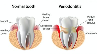 Teeth diseases and treatment