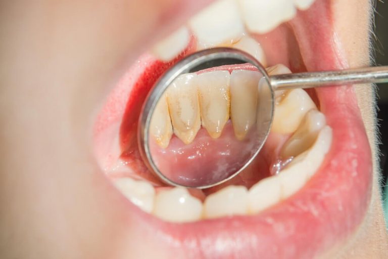 Teeth diseases and treatment