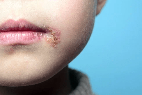 What is the best treatment for herpes? + video