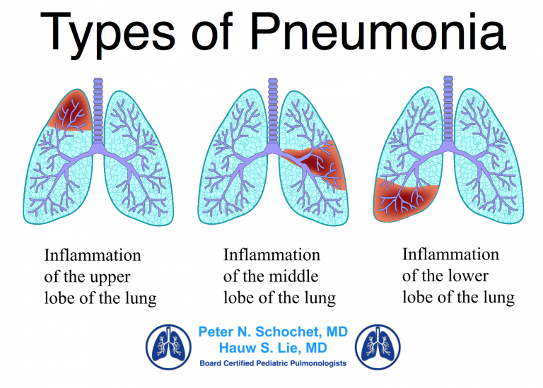 Symptoms Of Pneumonia Causes And Treatment Methods Greenbhl