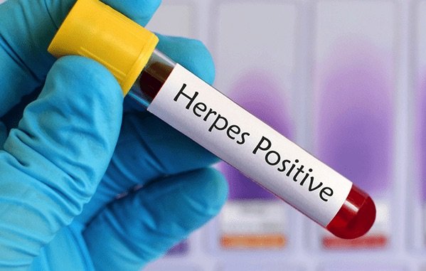 What is the best treatment for herpes? + video