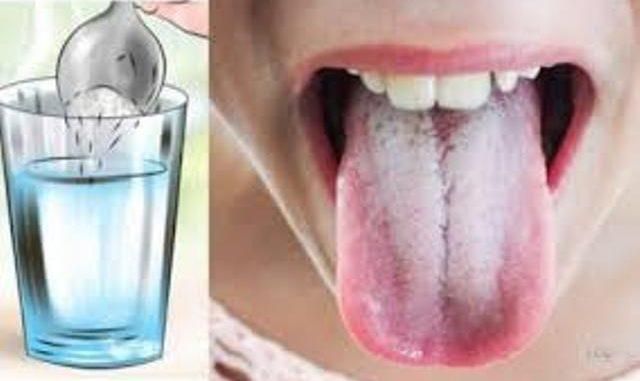 Can you treat white tongue at home?
