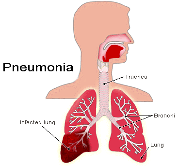 What are the first signs of pulmonary fibrosis?