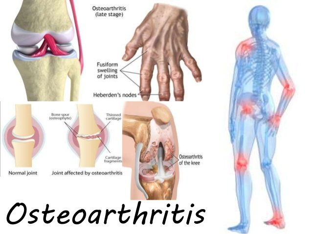 How I cured my osteoarthritis naturally