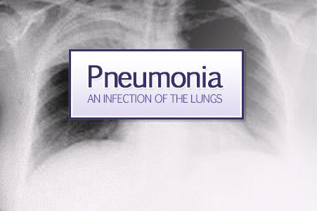 Fibrosis pulmonar : causas, tratamiento + vídeo