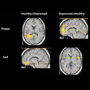 myths and facts about depression and anxiety