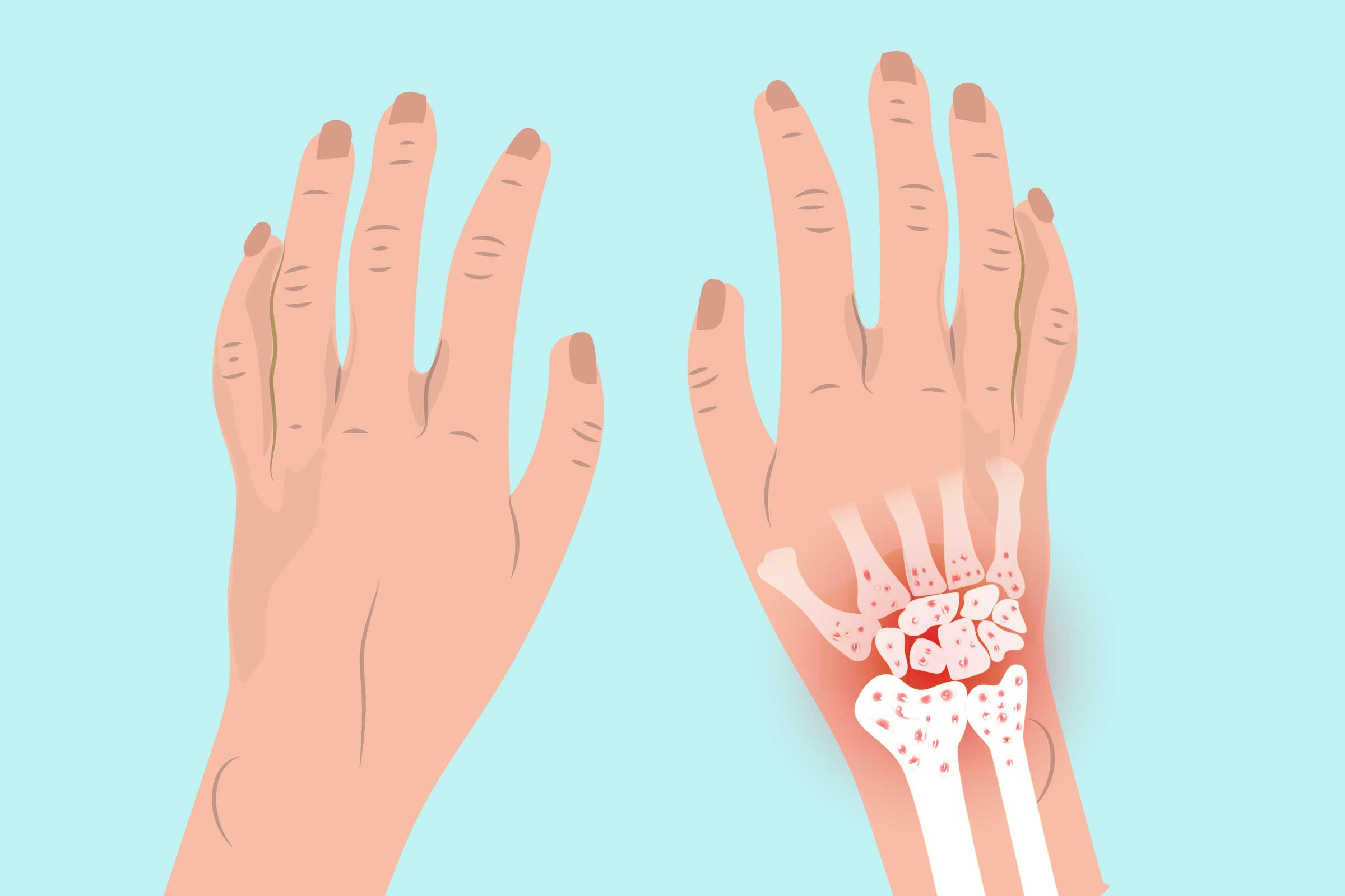 What are the main symptoms of arthritis?