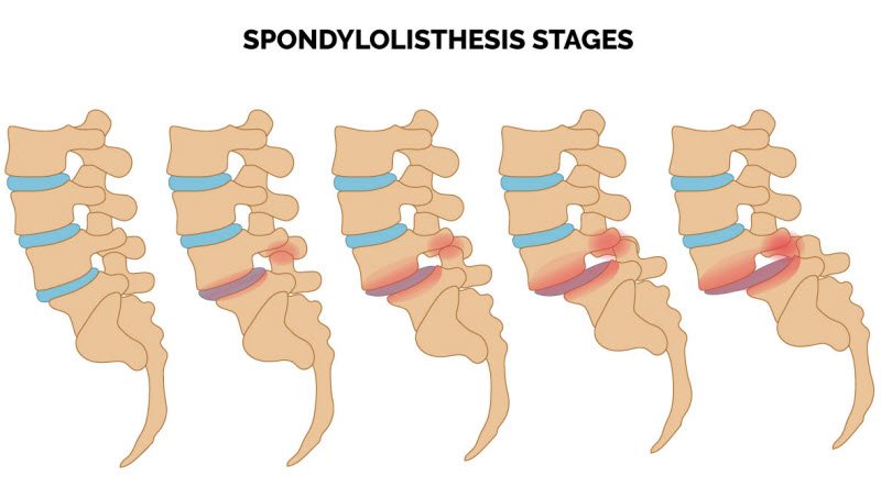 What are the types of Low back pain? List of types and treatment