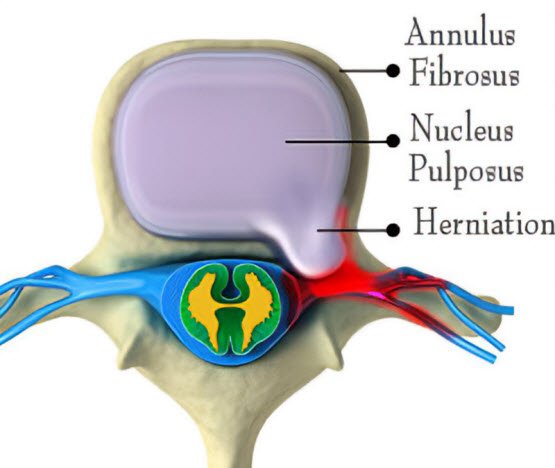 What are the types of Low back pain? List of types and treatment