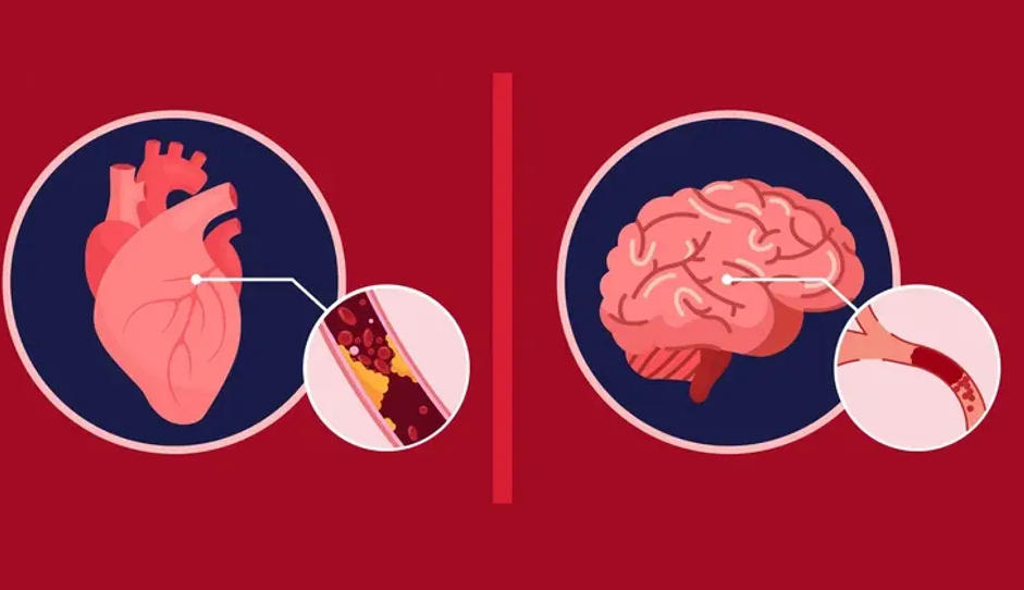 Las diferencias entre los síntomas de un accidente cerebrovascular y un ataque al corazón