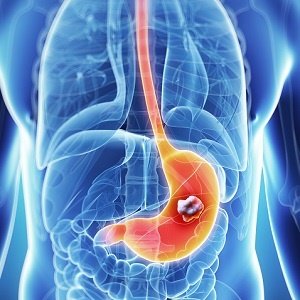 How to detect stomach cancer early