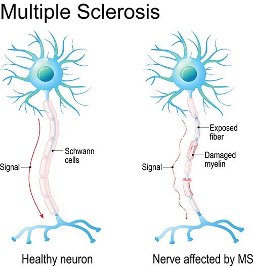 What are usually the first signs of MS