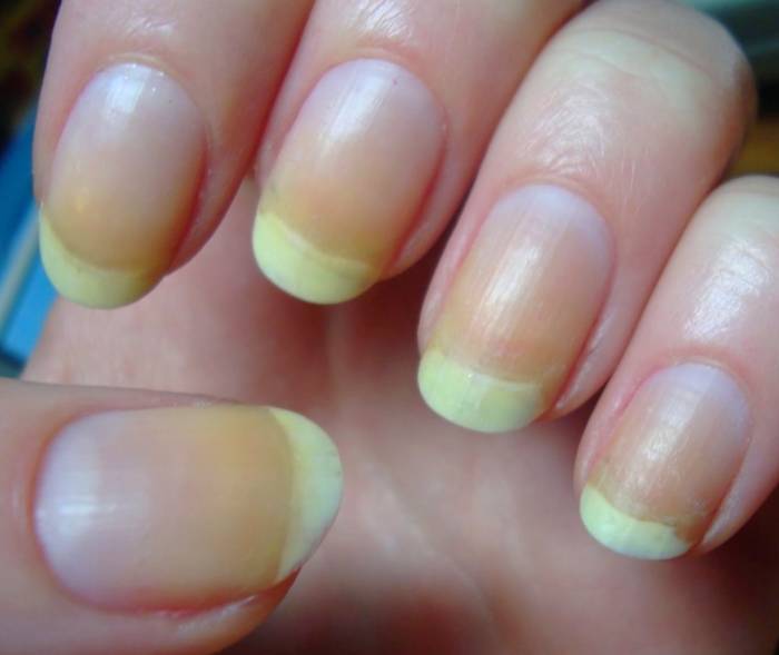 What disease causes yellow nails? + video