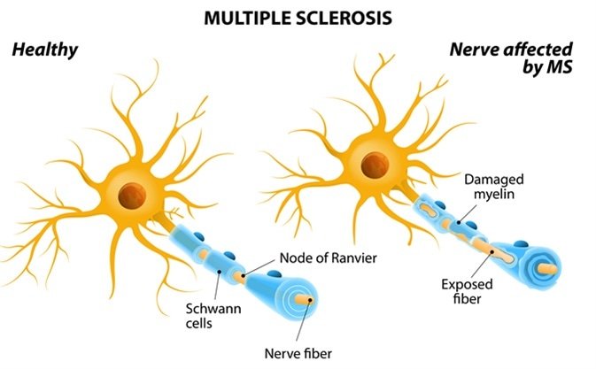 What are usually the first signs of MS