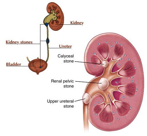 kidney stones