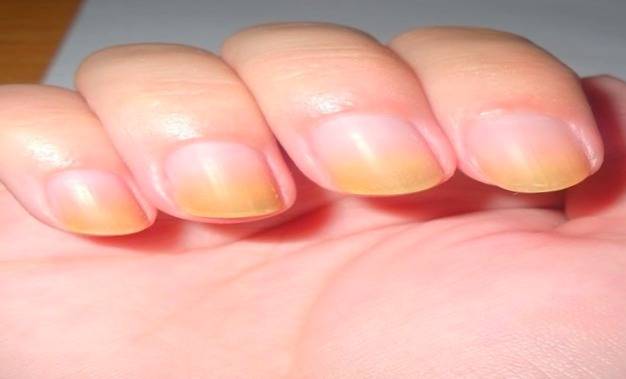 what-are-the-symptoms-of-yellowing-of-fingernails-and-toenails-greenbhl