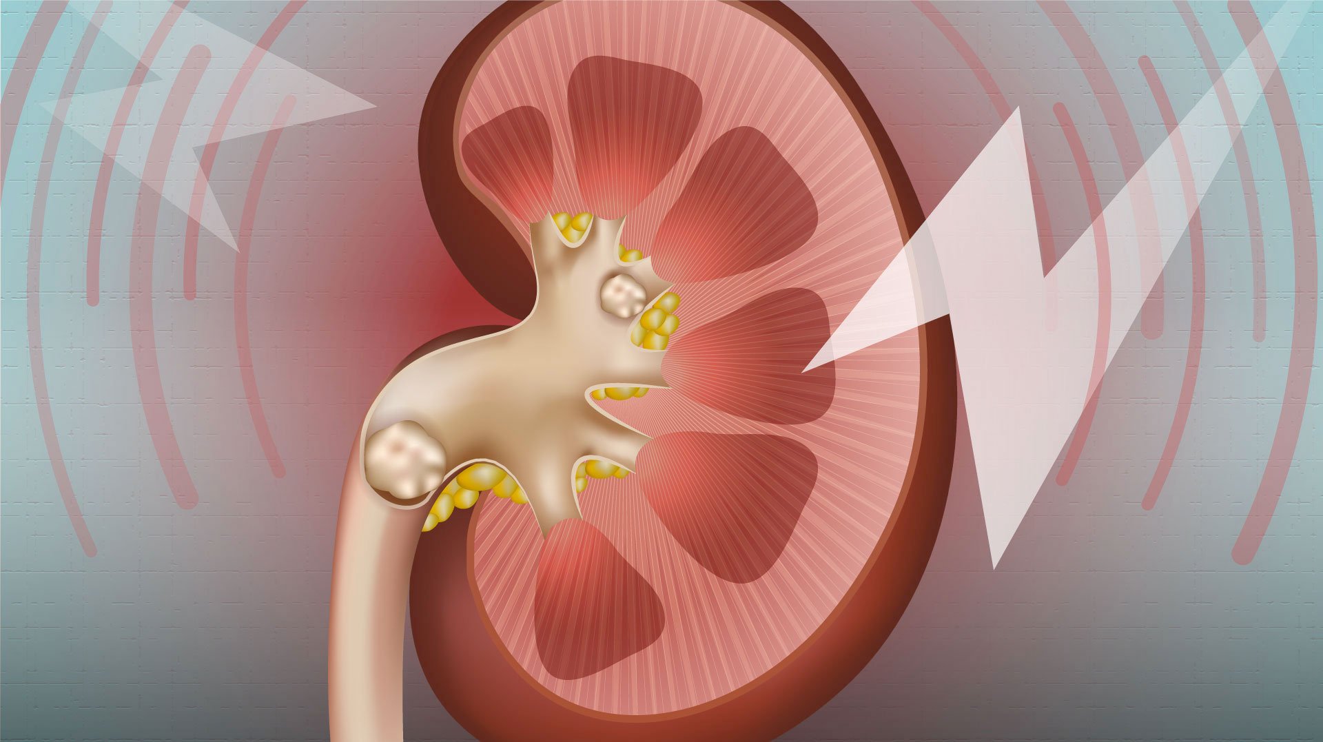The symptoms of kidney stones and how to treat them +video