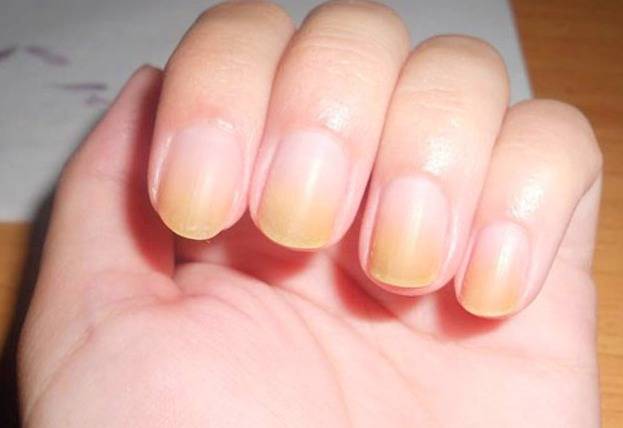 Causes of yellowing of the nail bed - wide 5