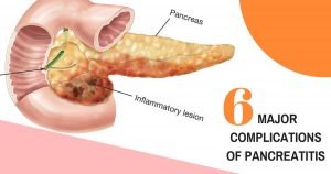 Causes of pancreatitis and its home treatment