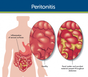 Symptoms of intestinal adhesions and their treatment + video