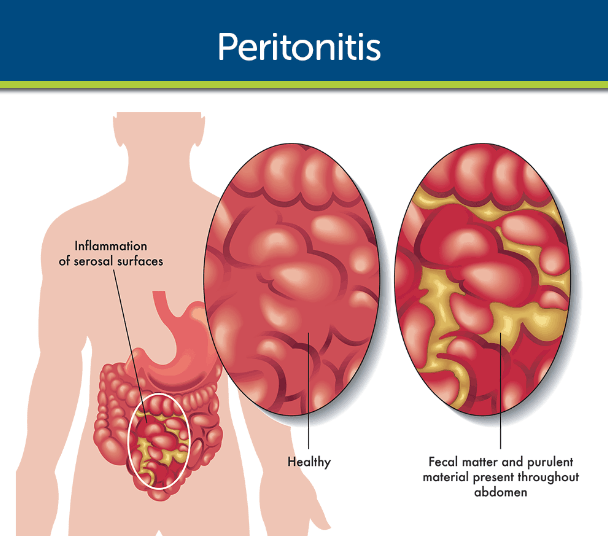 Peritonitis System Disorder Template