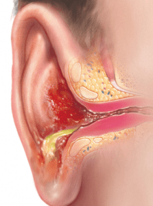 Learn everything you need to know about ear washing