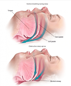 Does a disease cause salivation in sleep?