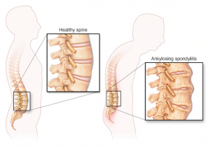 What are the main symptoms of arthritis?