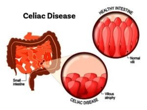 Autoimmune diseases; Causes, symptoms, types, and methods of treatment