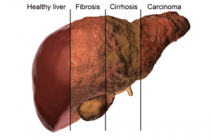 What is the best way to reduce fatty liver naturally?