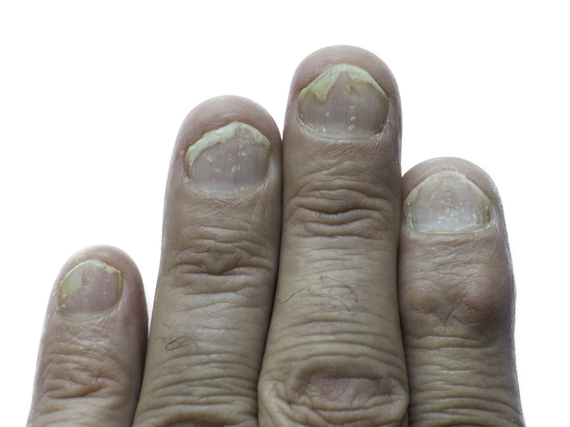Treatment of nail psoriasis with herbal medicine