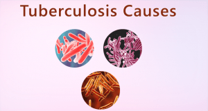 Tuberculosis: Everything about the symptoms, diagnosis and treatment of tuberculosis