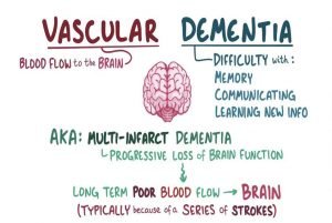 Alzheimer's disease - Everything about dementia and its symptoms