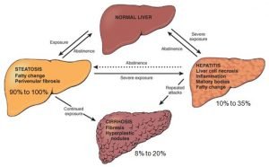 What is the best way to reduce fatty liver naturally?