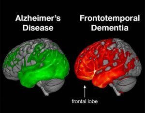 Alzheimer's disease