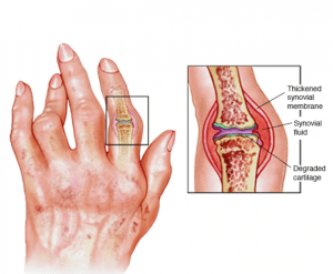 Autoimmune diseases; Causes, symptoms, types, and methods of treatment