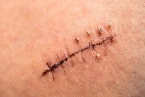 Sutures and surgical wounds: how to care for them properly