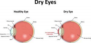 Causes of "dry eye" and the best ways to treat it