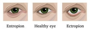 Causes of "dry eye" and the best ways to treat it