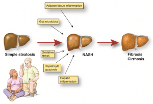 What is the best way to reduce fatty liver naturally?