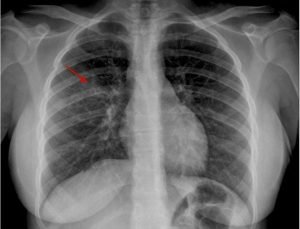 Symptoms that confirm pneumonia