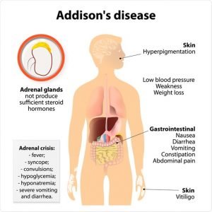 Autoimmune diseases; Causes, symptoms, types, and methods of treatment