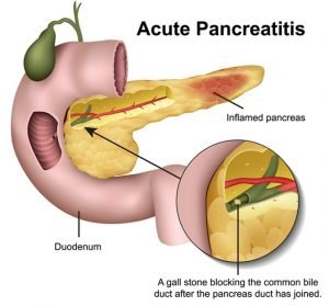 Causes of pancreatitis and its home treatment