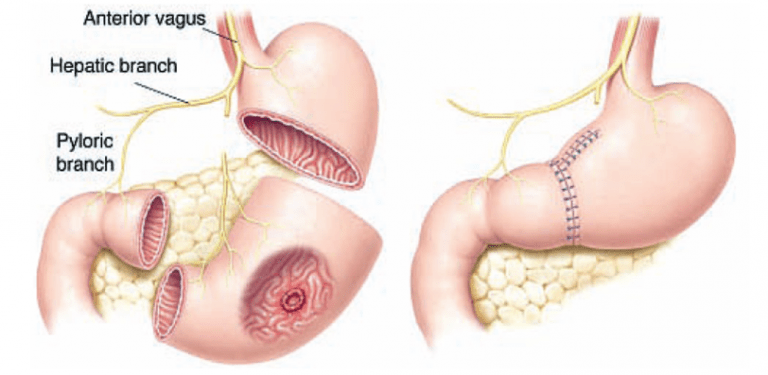 How to detect stomach cancer early