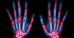 What are the main symptoms of arthritis?