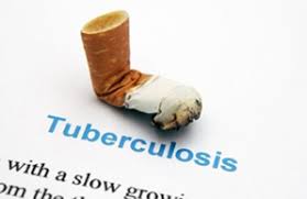 Tuberculosis: Everything about the symptoms, diagnosis and treatment of tuberculosis