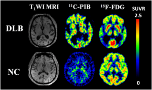 Alzheimer's disease - Everything about dementia and its symptoms